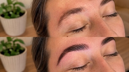 browlift