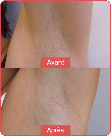 epilationaisselles_letempsdunsoin